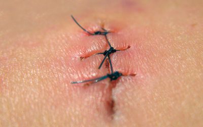 Reducir la cicatriz tras prostatectomía radical